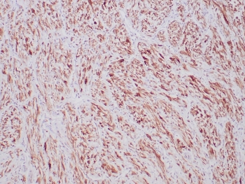 ALK Antibody / Anaplastic Lymphoma Kinase