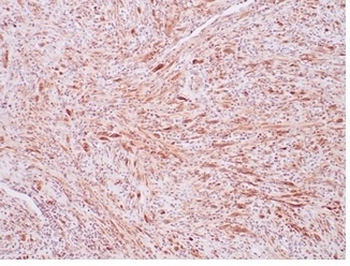 ALK Antibody / Anaplastic Lymphoma Kinase