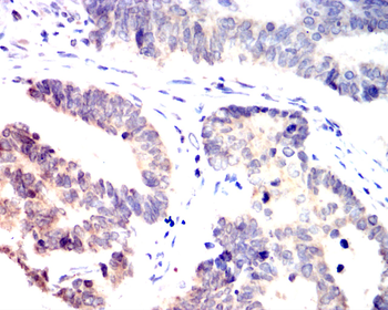 Immunohistochemical analysis of paraffin-embedded human colon cancer tissues using ERG antibody with DAB staining. Pre-treat the sections with heat-mediated antigen retrieval using sodium citrate buffer (pH 6.0) for 2 minutes. Wash the sections with ddH2O and PBS. Block the tissue with 10% non-immune goat serum at room temperature for 30 minutes. Incubate the tissue with the primary antibody diluted at a ratio of 1:1500 at 4C overnight. At room temperature, dilute the secondary antibody, Goat Anti-Rabbit IgG (H&amp;L)-HRP, at a ratio of 1:200 and incubate for one hour. Use DAB as the chromogenic agent. Counterstain the tissue with hematoxylin, and mount the tissue sections with neutral gum.