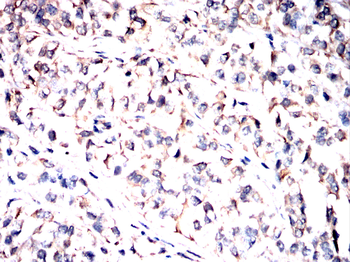 Immunohistochemical analysis of paraffin-embedded bladder cancer tissues using ACE2 antibody with DAB staining. Pre-treat the sections with heat-mediated antigen retrieval using sodium citrate buffer (pH 6.0) for 2 minutes. Wash the sections with ddH2O and PBS. Block the tissue with 10% non-immune goat serum at room temperature for 30 minutes. Incubate the tissue with the primary antibody diluted at a ratio of 1:500 at 4C overnight. At room temperature, dilute the secondary antibody, Goat Anti-Mouse IgG (H&amp;L)-HRP, at a ratio of 1:200 and incubate for one hour. Use DAB as the chromogenic agent. Counterstain the tissue with hematoxylin, and mount the tissue sections with neutral gum.