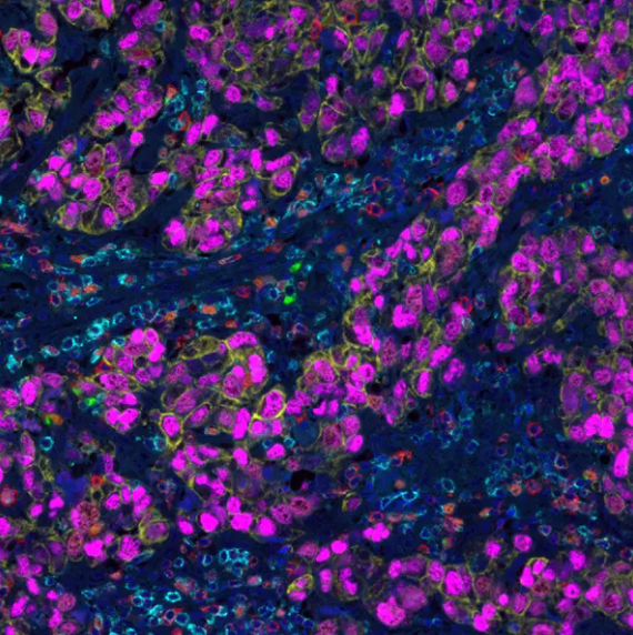 Cell Proliferation and Metastasis PathPlex Panel (CD3E, Granzyme B, CD8 alpha, Cytokeratin, Ki-67, SOX10)