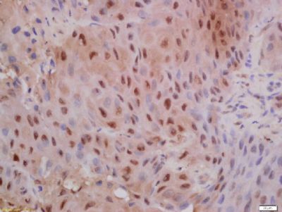 Immunohistochemical staining of human laryngocarcinoma tissue using E Cadherin (Phospho-Ser838 + Ser840) antibody.