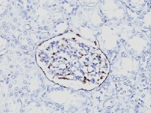 Wilm’s Tumor 1 (WT1) (Wilm’s Tumor & Mesothelial Marker) Antibody