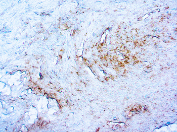 TREPONEMA PALLIDUM Antibody