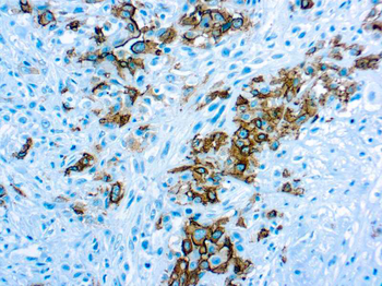 MESOTHELIOMA Antibody