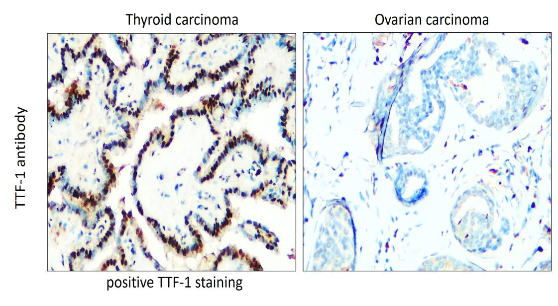 TTF-1 / NKX2-1 / Thyroid Transcription Factor