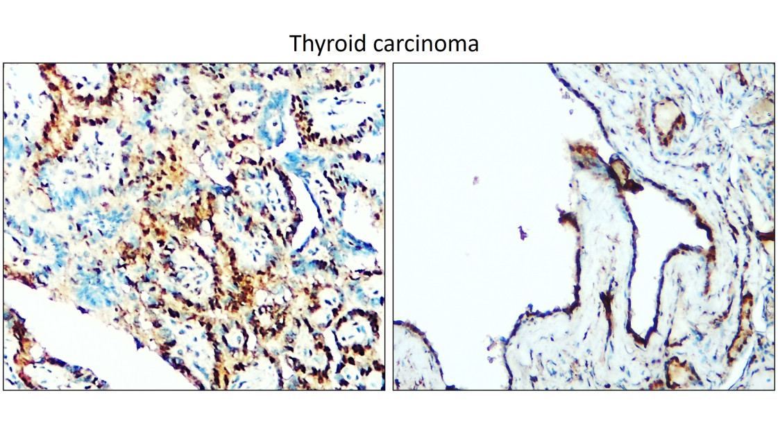 TTF-1 / NKX2-1 / Thyroid Transcription Factor