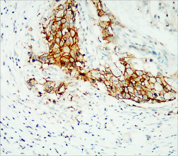 Breast Cancer Biomarkers Antibody Panel