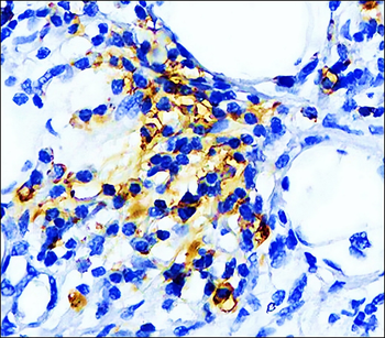 Lung cancer biomarkers Antibody Panel