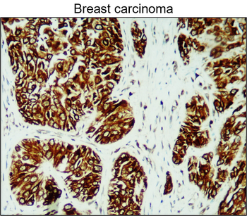 Lung cancer biomarkers Antibody Panel
