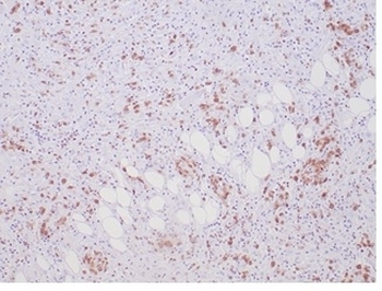 ALK Antibody / Anaplastic Lymphoma Kinase