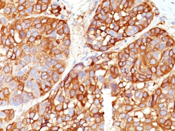 Melanoma Marker Antibody Cocktail (MART-1 & Tyrosinase & gp100)