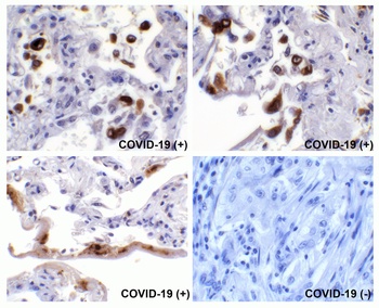 SARS-CoV-2 (COVID-19) Spike Antibody