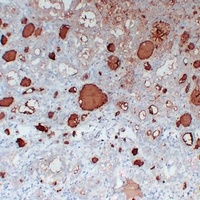 Thyroglobulin antibody