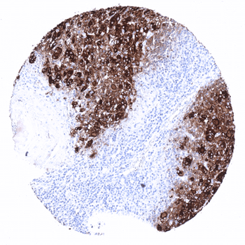 Thyroglobulin antibody