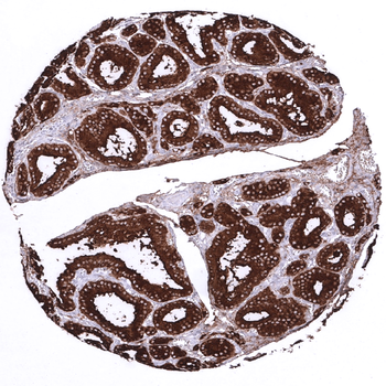 Thyroglobulin antibody