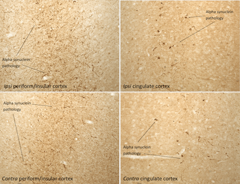 Alpha Synuclein Pre-formed Fibrils (Type 1)