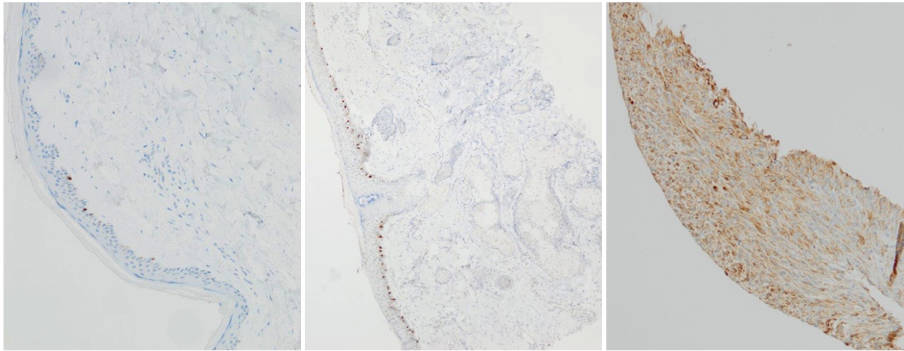 AVS Bio - mouse anti-human Mart-1, IHC on melanoma tissue
