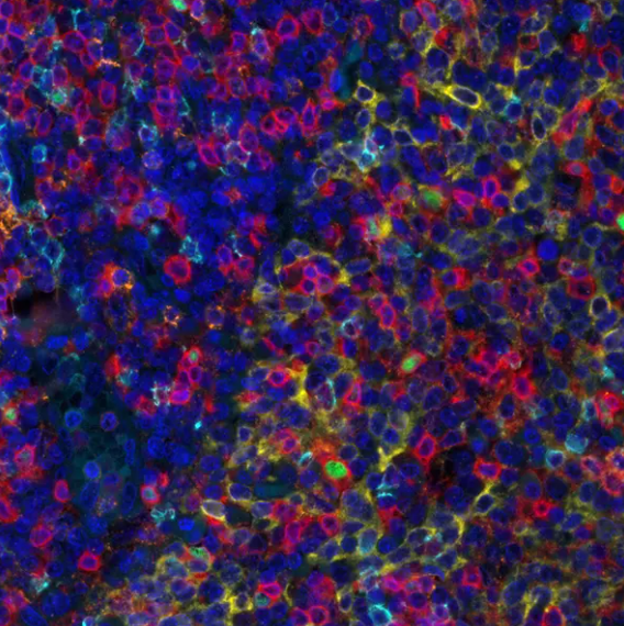 T Cell Maturation PathPlex Panel (CD8 alpha, Cytokeratin, CD45RO, CD4, FOXP3)