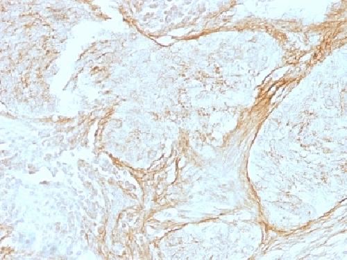 Tenascin C (Stromal Marker for Epithelial Malignancy) Antibody